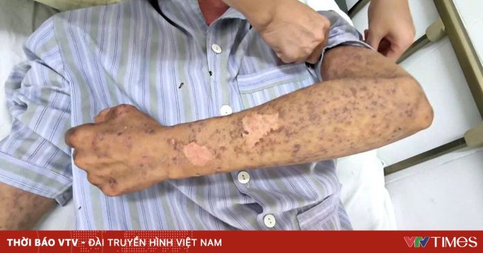 Bỏng rát toàn thân, mù tạm thời vì silicon chống dột mái nhà