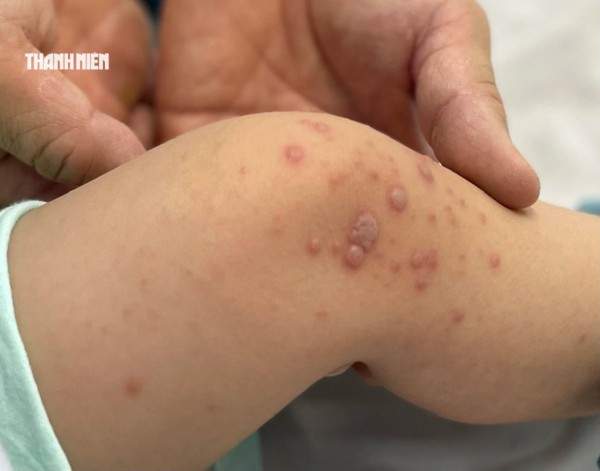 TP.HCM: Bệnh tay chân miệng tăng mạnh, hơn 8.150 ca mắc, 4 ca tử vong