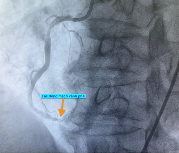 1 ngày 4 ca nhồi máu cơ tim cấp nhập viện, có bất thường?