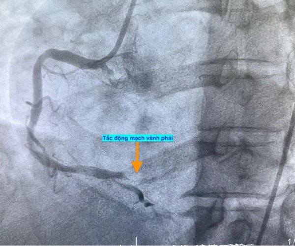 1 ngày 4 ca nhồi máu cơ tim cấp nhập viện, có bất thường?