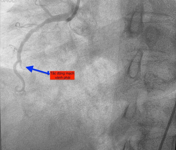 1 ngày 4 ca nhồi máu cơ tim cấp nhập viện, có bất thường?