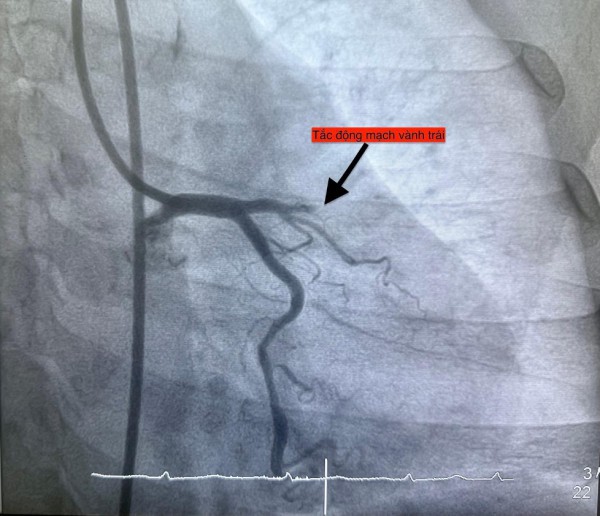 1 ngày 4 ca nhồi máu cơ tim cấp nhập viện, có bất thường?