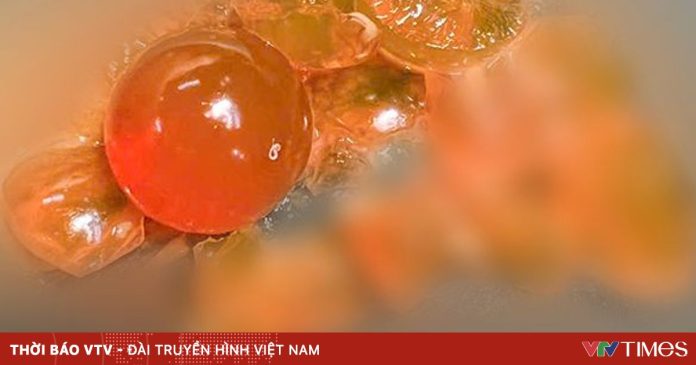 Bé trai 14 tháng tuổi phải mổ cấp cứu vì nuốt hạt nở