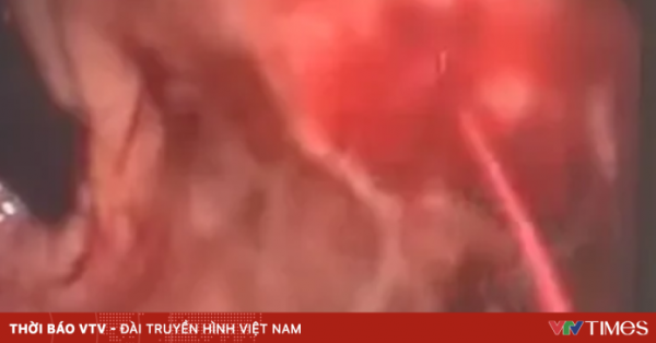 Bệnh nhân nguy kịch vì chảy máu ruột non hiếm gặp