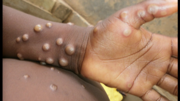 Bộ Y tế yêu cầu tăng cường phòng chống bệnh đậu mùa khỉ