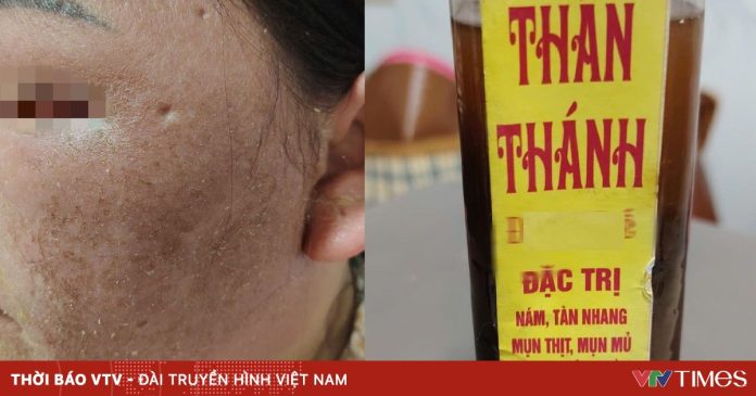 Cảnh báo nguy cơ tổn thương da do dùng “thuốc bôi thần thánh” trôi nổi