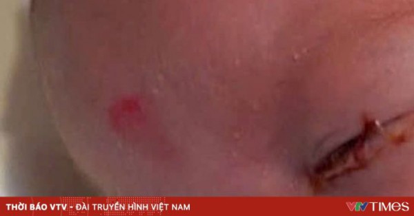 Cảnh báo viêm kết mạc ở trẻ sơ sinh