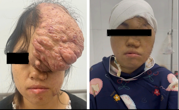 Cô gái Sơn La mang khối u sọ 15 năm được mổ thành công ở Bình Dương Cô gái Sơn La mang khối u sọ 15 năm được mổ thành công ở Bình Dương