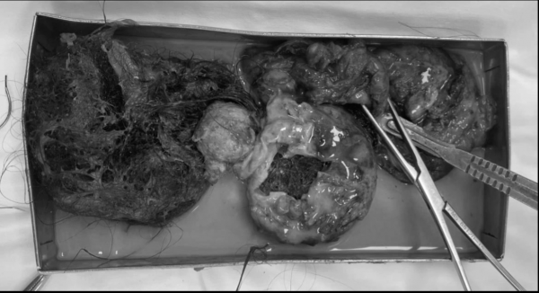 Cứu nữ bệnh nhân vỡ u quái buồng trứng, răng và tóc tràn ra ổ bụng