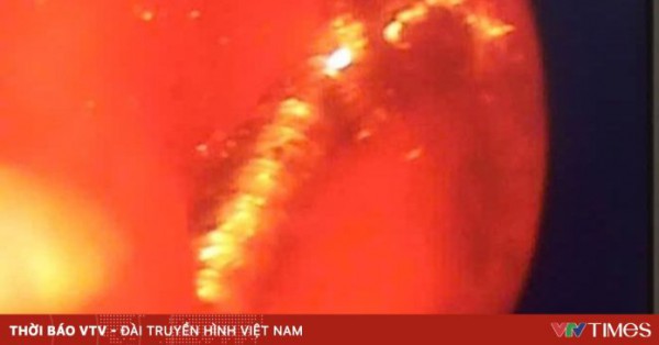 Gắp thành công đinh vít dài trong thực quản bệnh nhân 54 tuổi