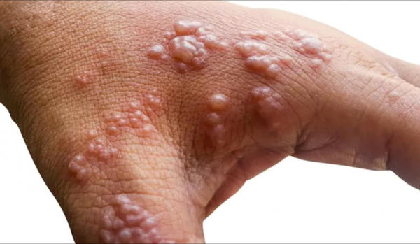 Góc giải đáp: Bệnh đậu mùa khỉ khác gì đậu mùa thường?