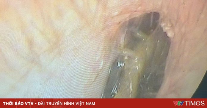Hy hữu: Gắp thành công con rết còn sống trong ống tai người đàn ông