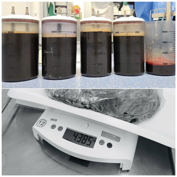 Khối u buồng trứng hơn 20 kg nhưng tưởng tăng cân