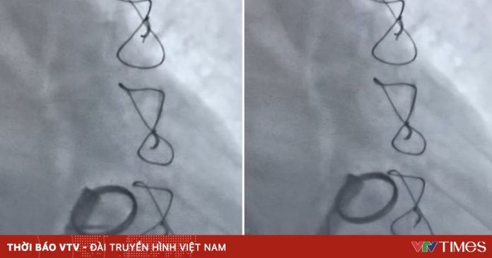 Kịp thời tiêu sợi huyết cứu bệnh nhân bị huyết khối kẹt van tim nhân tạo