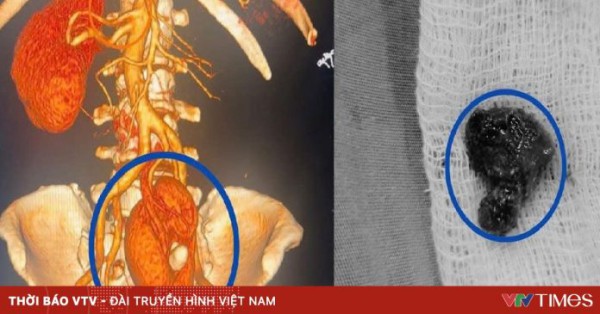 Lấy sỏi thận cho một trường hợp thận lạc chỗ hiếm gặp