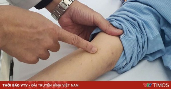 Nam thanh niên 24 tuổi ở Hà Nội mắc bệnh não mô cầu