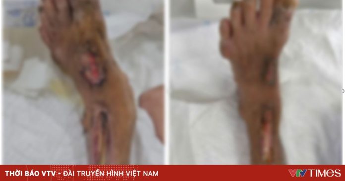 Nguy cơ tử vong từ thói quen xử lý vết mủ sai cách