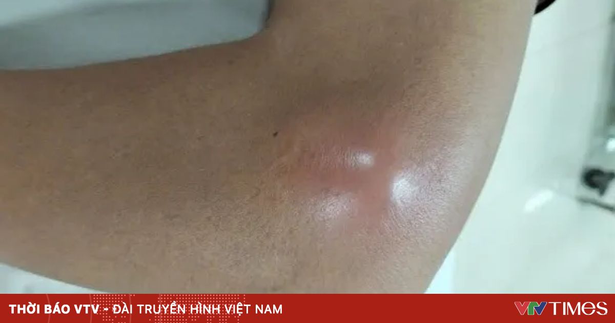 Nguy hiểm khó lường khi tiêm khớp không an toàn