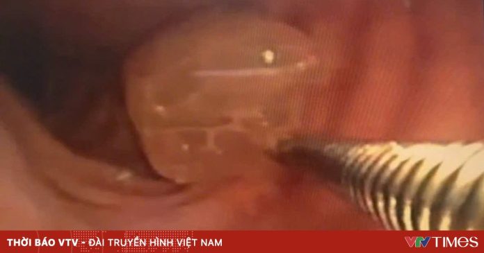 Nguy kịch vì nửa quả nho mắc kẹt ở phế quản