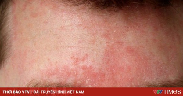 Những bệnh da thường gặp trong mùa lạnh