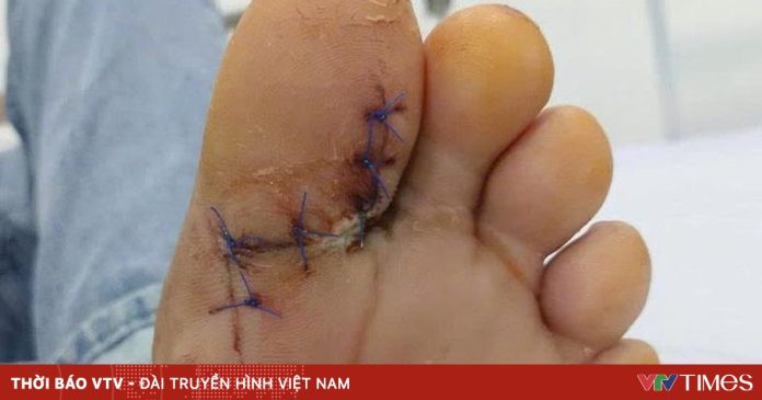 Phát hiện đái tháo đường type 2 từ vết thương bàn chân lâu lành
