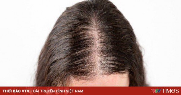 Phát hiện tình cờ loại đường giúp đảo ngược rụng tóc di truyền mà không cần thuốc