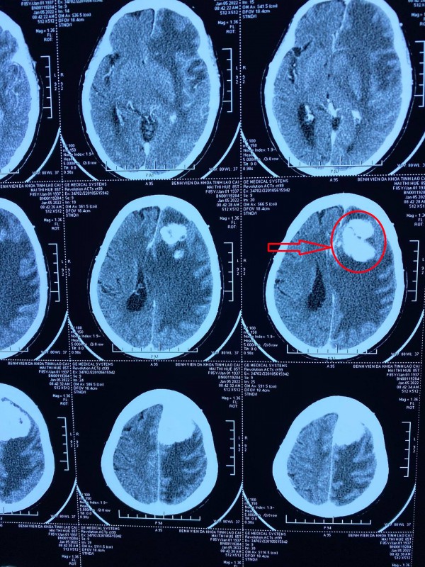 Phẫu thuật khối u não kích thước lớn cho bệnh nhân cao tuổi