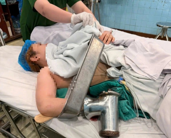 TP.HCM: Người phụ nữ đi cấp cứu với bàn tay phải dính chặt trong máy xay thịt