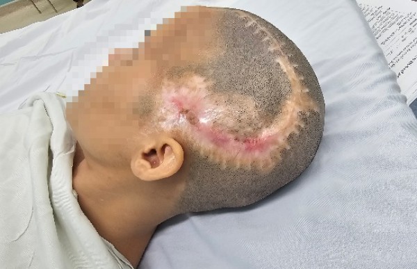 TP.HCM: Đột quỵ sau phẫu thuật thẩm mỹ hút mỡ bụng, cấy mỡ