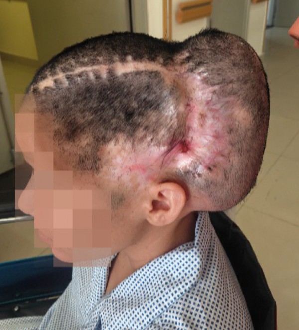 TP.HCM: Đột quỵ sau phẫu thuật thẩm mỹ hút mỡ bụng, cấy mỡ