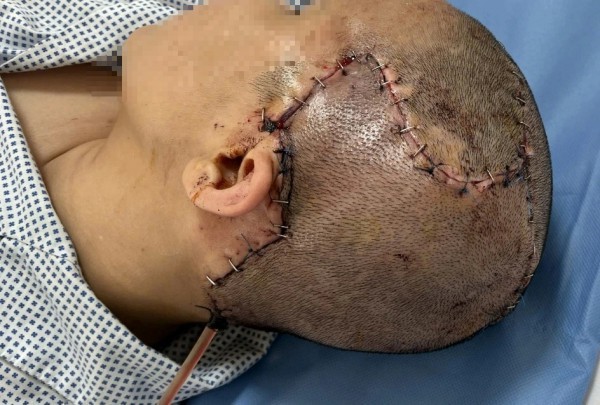 TP.HCM: Đột quỵ sau phẫu thuật thẩm mỹ hút mỡ bụng, cấy mỡ