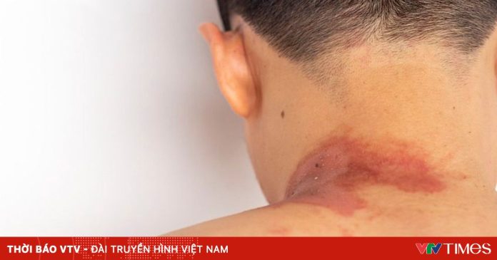 Thoát sốc phản vệ sau khi bị kiến ba khoang cắn