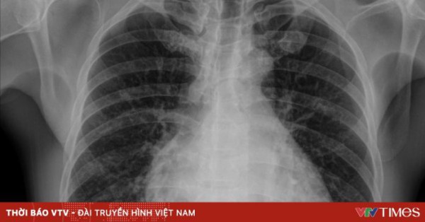 Tổn thương phổi – nguyên nhân hàng đầu gây tử vong liên quan truyền máu