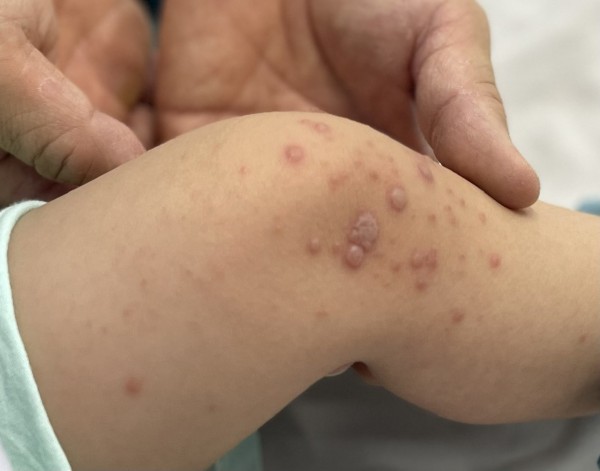 Việt Nam chờ vắc xin tay chân miệng nhập về hạ nhiệt dịch