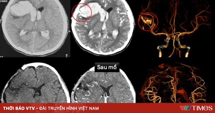 Đang ngủ, bé gái 13 tuổi đột ngột hôn mê do vỡ mạch máu não