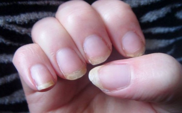 Cách chăm sóc và phục hồi móng tay yếu, dễ gãy
