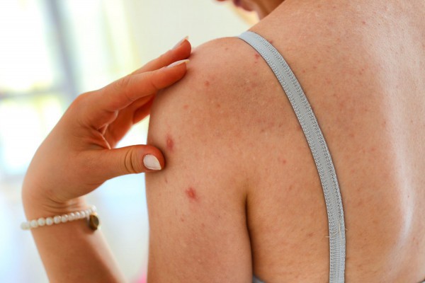 Cách điều trị mụn cơ thể và ngăn ngừa mụn vào mùa hè