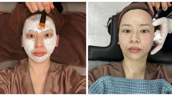 Tiêm tinh chất cá hồi: Cảnh giác với bẫy thẩm mỹ trong các 