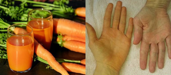 Ăn nhiều cà rốt, cà chua có thể khiến da đổi màu