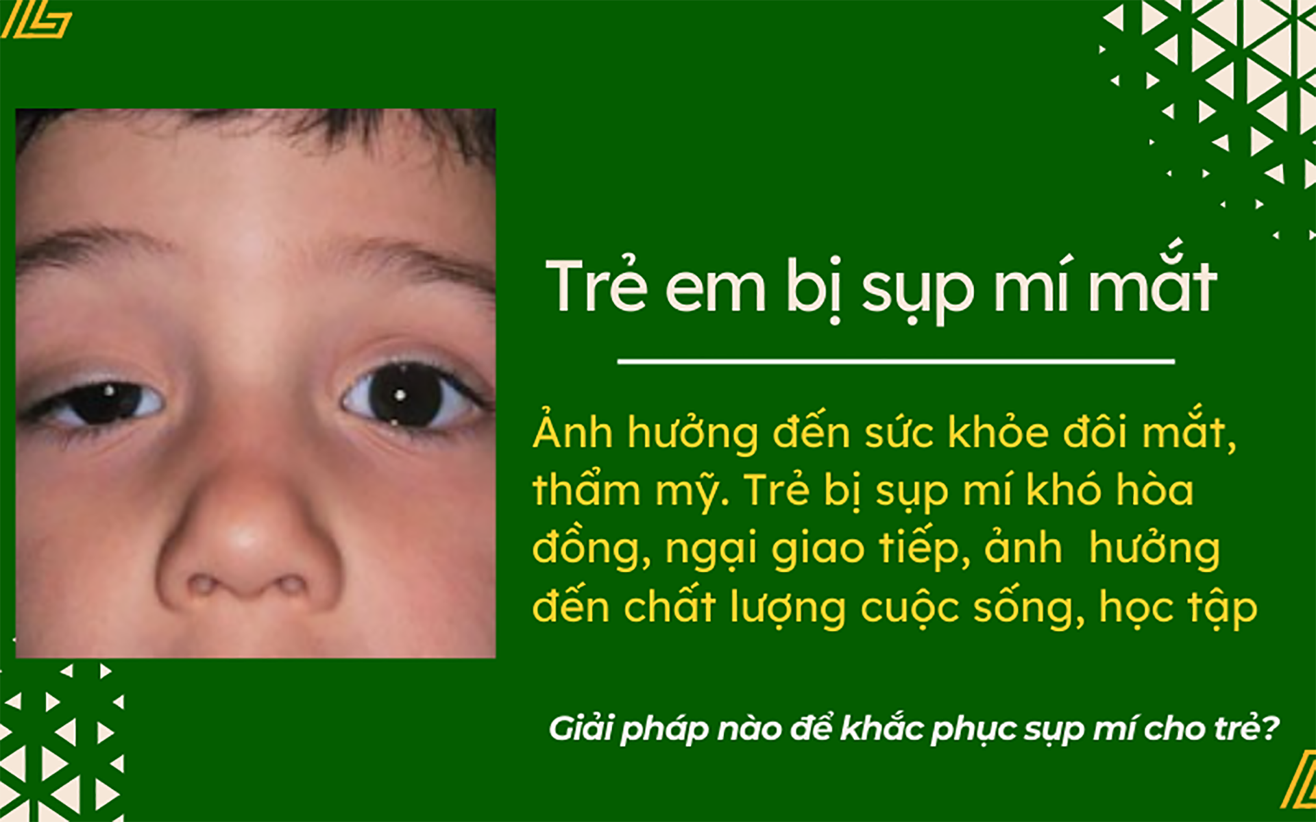 Các phương pháp điều trị sụp mí mắt cho trẻ em an toàn, hiệu quả