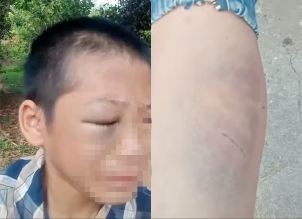 Bé trai nghi bị mẹ kế và bố đẻ đánh phải nhập viện điều trị
