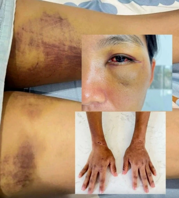 Lâm Đồng: Bắt giữ chồng cũ nạn nhân trong vụ ‘tra tấn em dâu để trừ tà’ Lâm Đồng: Bắt giữ chồng cũ nạn nhân trong vụ ‘tra tấn em dâu để trừ tà’