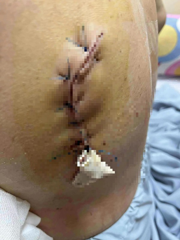 Điều tra vụ người phụ nữ bị con riêng của ba chồng dùng dao tấn công