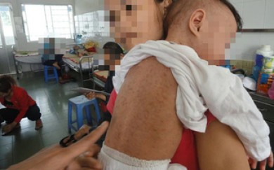 TP.HCM: Nhiều trẻ mắc sởi do cha mẹ ‘quên’ đưa con đi tiêm vắc xin