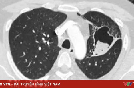 Cắt u nấm phổi phức tạp cho bệnh nhân trẻ tuổi