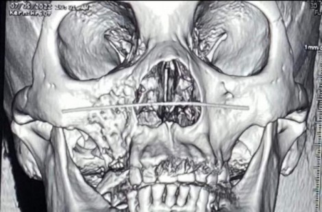Hoại tử xương sọ - mặt trên bệnh nhân từng mắc Covid-19: Đề nghị nơi tiếp nhận hội chẩn, báo cáo