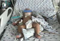 Cứu sống bé 7 tháng tuổi bị sốc sốt xuất huyết nặng