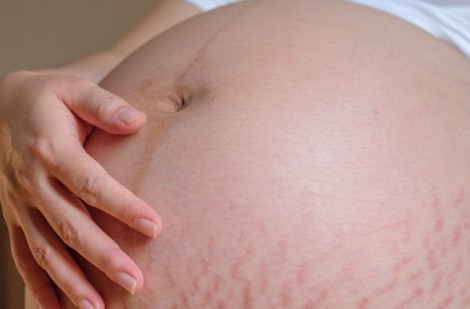 Mách bạn bí quyết hạn chế rạn da khi đang mang thai hiệu quả