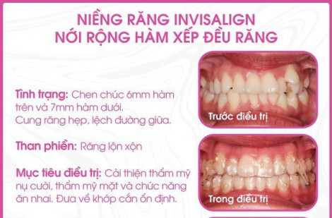 Niềng răng trong suốt có đau không, giai đoạn nào đau nhất?