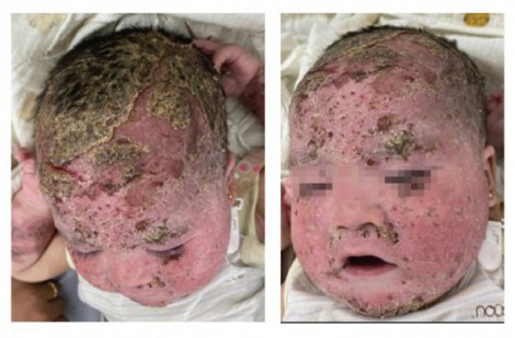 Bé trai bong tróc toàn bộ da mặt và da đầu do tắm lá điều trị viêm da cơ địa